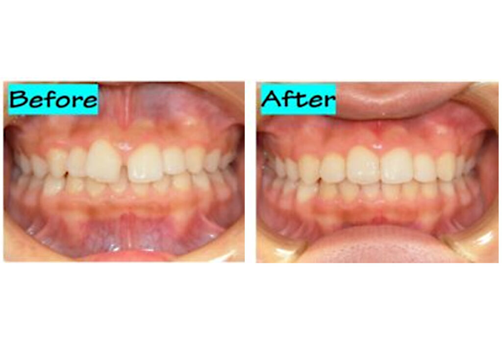 14歳6か月の男子｜実例写真あり