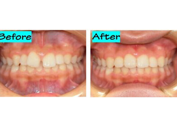 14歳6か月の男子｜実例写真あり