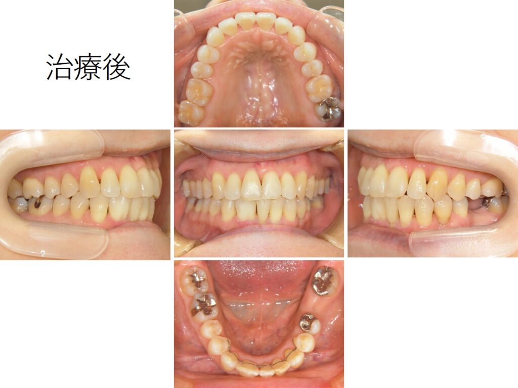 61歳の女性｜実例写真あり