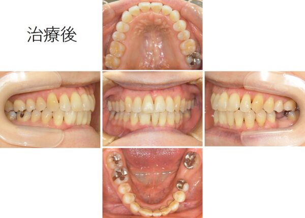 61歳の女性｜実例写真あり