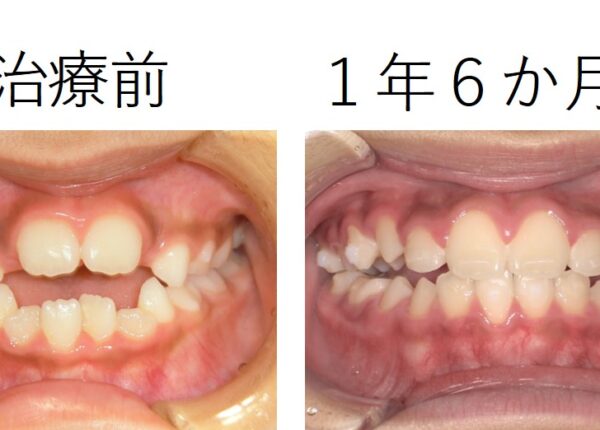 重度の開咬症例（インビザラインファースト）